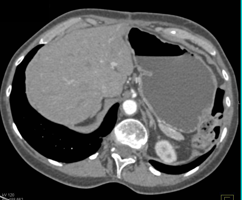 Medullary Sponge Kidney - CTisus CT Scan