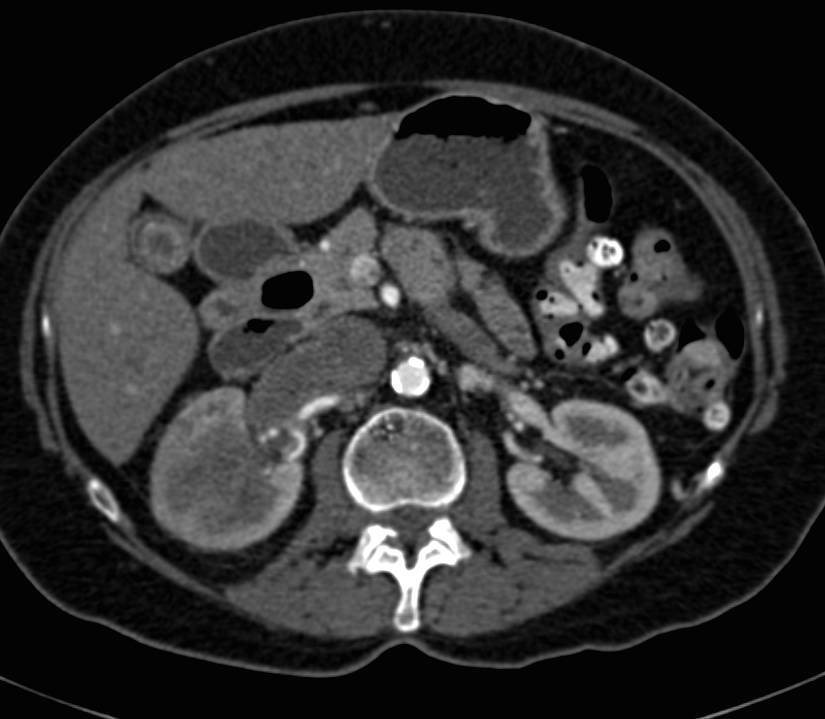 Transitional Cell Carcinoma with Extensive Renal Vein and Inferior Vena Cava (IVC) Thrombosis - CTisus CT Scan