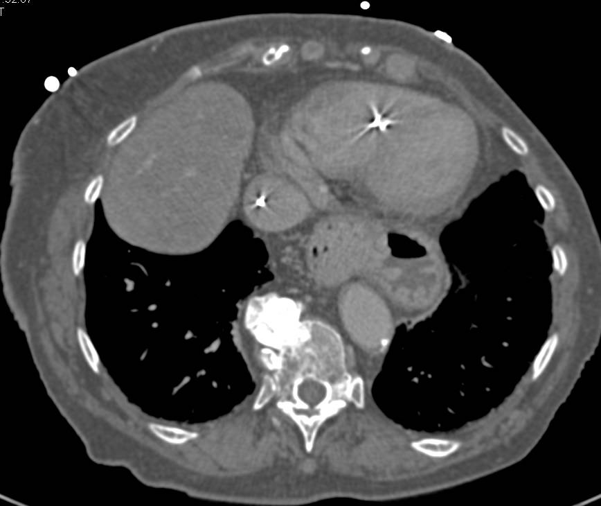 Broken Catheter is in Left Renal Vein - CTisus CT Scan