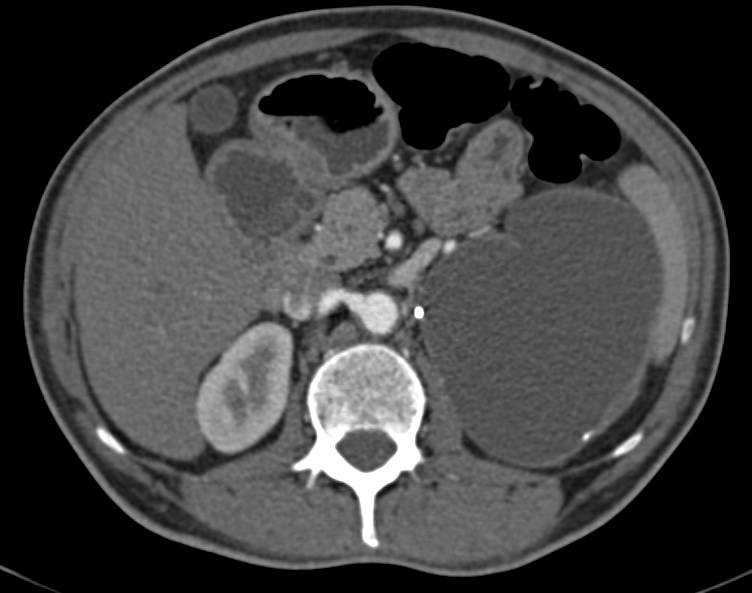 Lymphocele Following Partial Nephrectomy - CTisus CT Scan