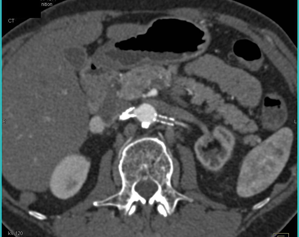 Bilateral Renal Artery Stents with Left Stent Occluded and Right Stent Narrowed - CTisus CT Scan