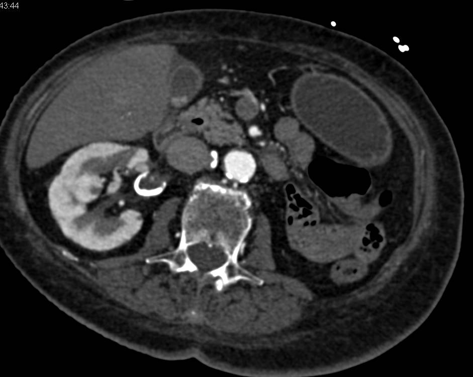 Right Renal Artery Aneurysm - CTisus CT Scan