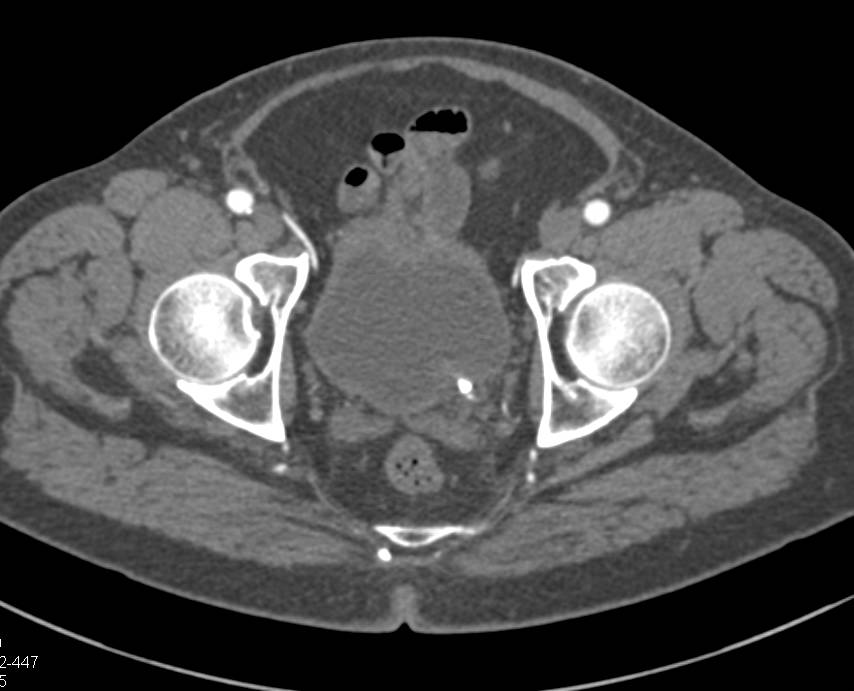 Stone in Distal Ureter Near Site of Tumor - CTisus CT Scan