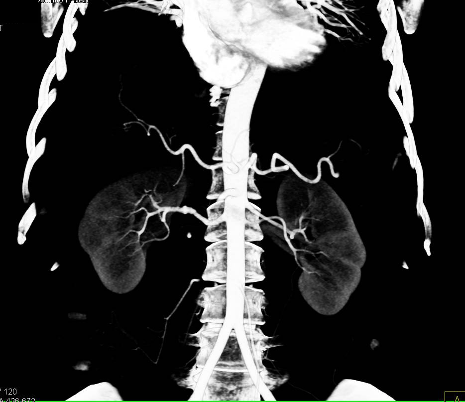Fibromuscular Hyperplasia (FMD) Right Renal Artery - CTisus CT Scan