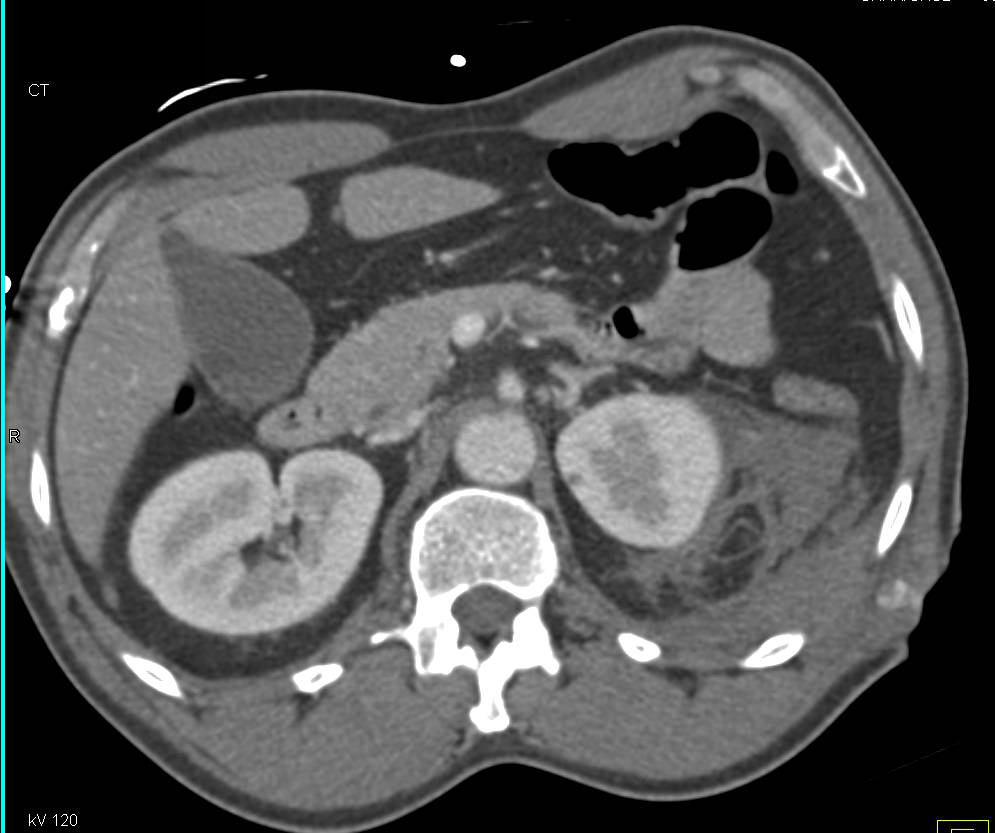 Renal Laceration with Hemoperitoneum - CTisus CT Scan