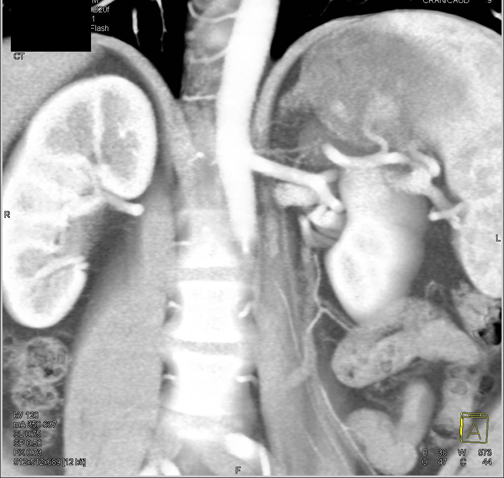 Accessory Renal Artery Upper Pole Left Kidney - CTisus CT Scan