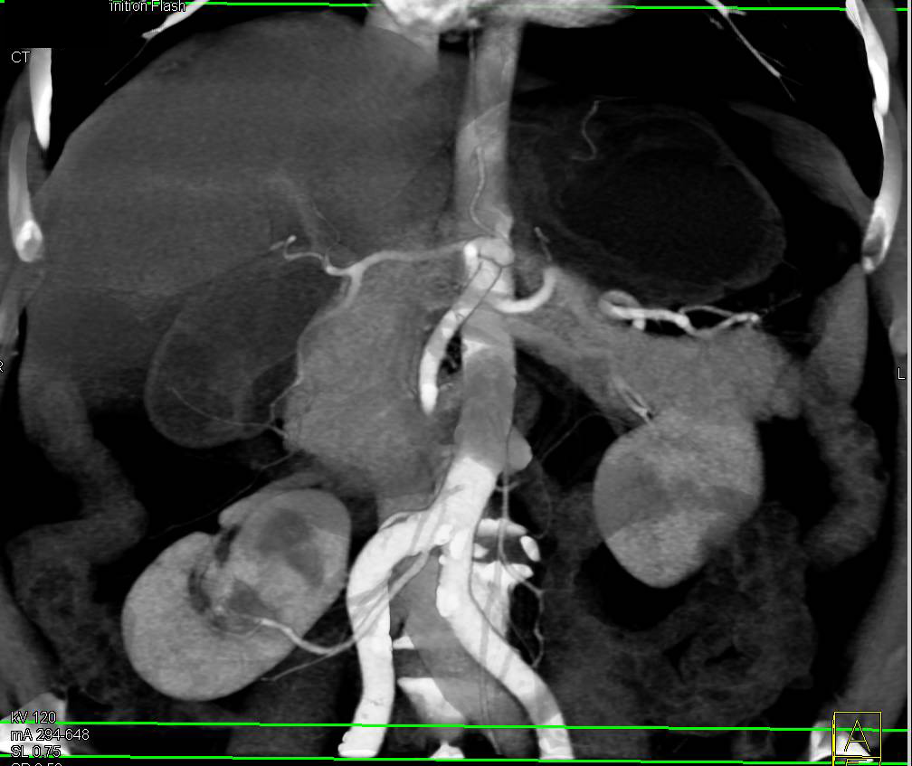 Multiple Right Renal Arteries - CTisus CT Scan