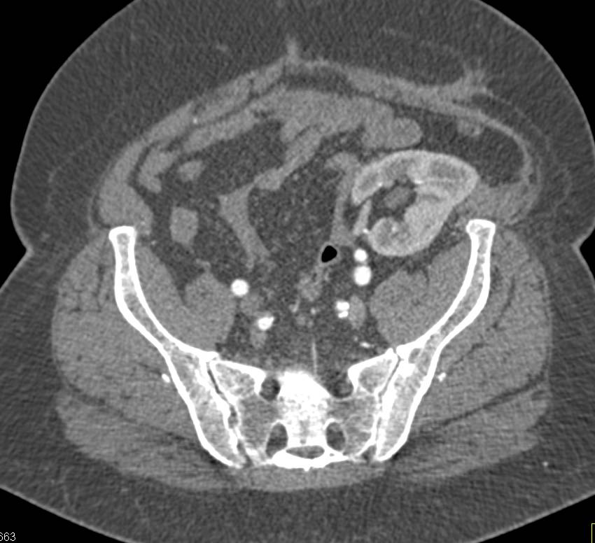 High Density Cyst in Left Kidney (native kidney) - CTisus CT Scan