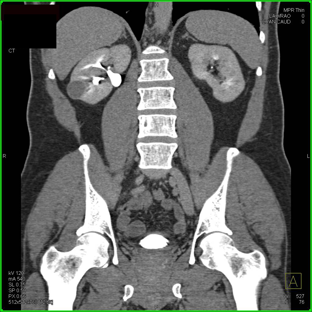 Cystic Renal Cell Carcinoma with Septations - CTisus CT Scan