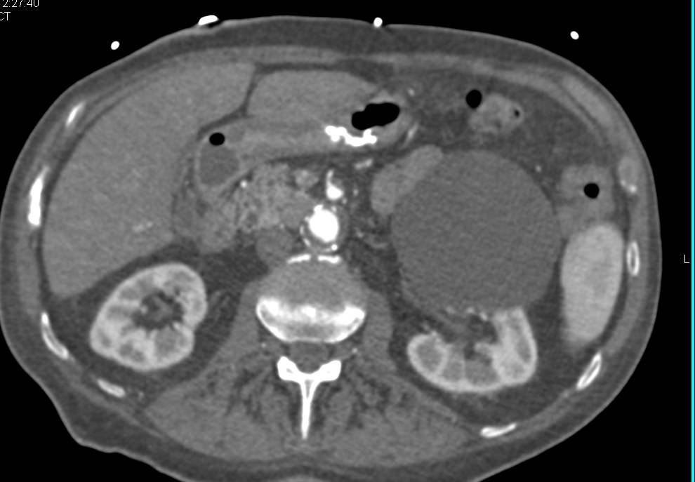Large Renal Cyst - CTisus CT Scan