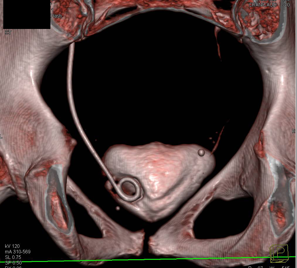 Left Ureteral Stent Within Distal Ureter and not in Bladder - CTisus CT Scan