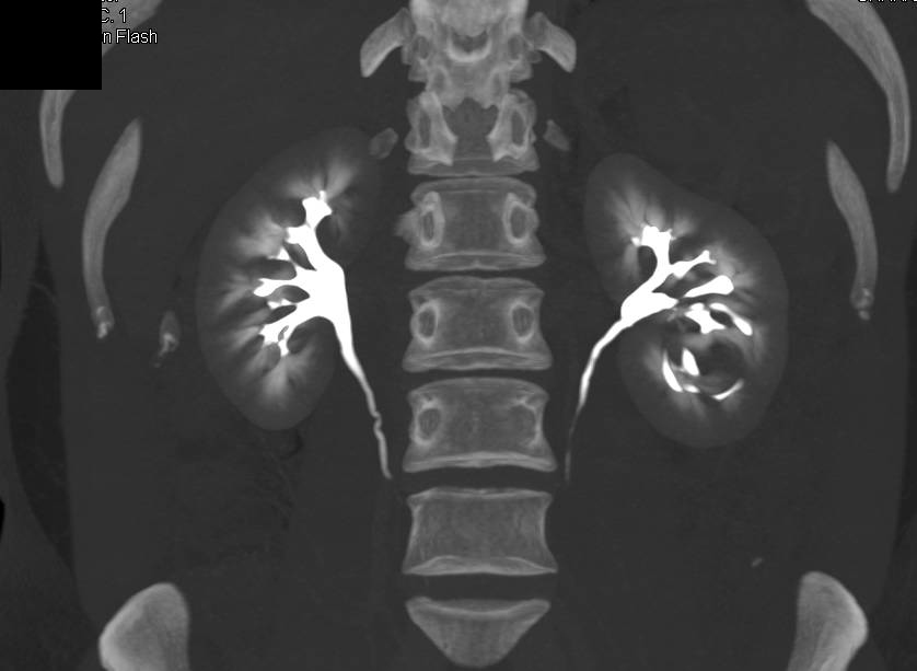 Renal Carcinoma with Post Operative Changes Following a Partial Nephrectomy (pre and post-op scans shown) - CTisus CT Scan