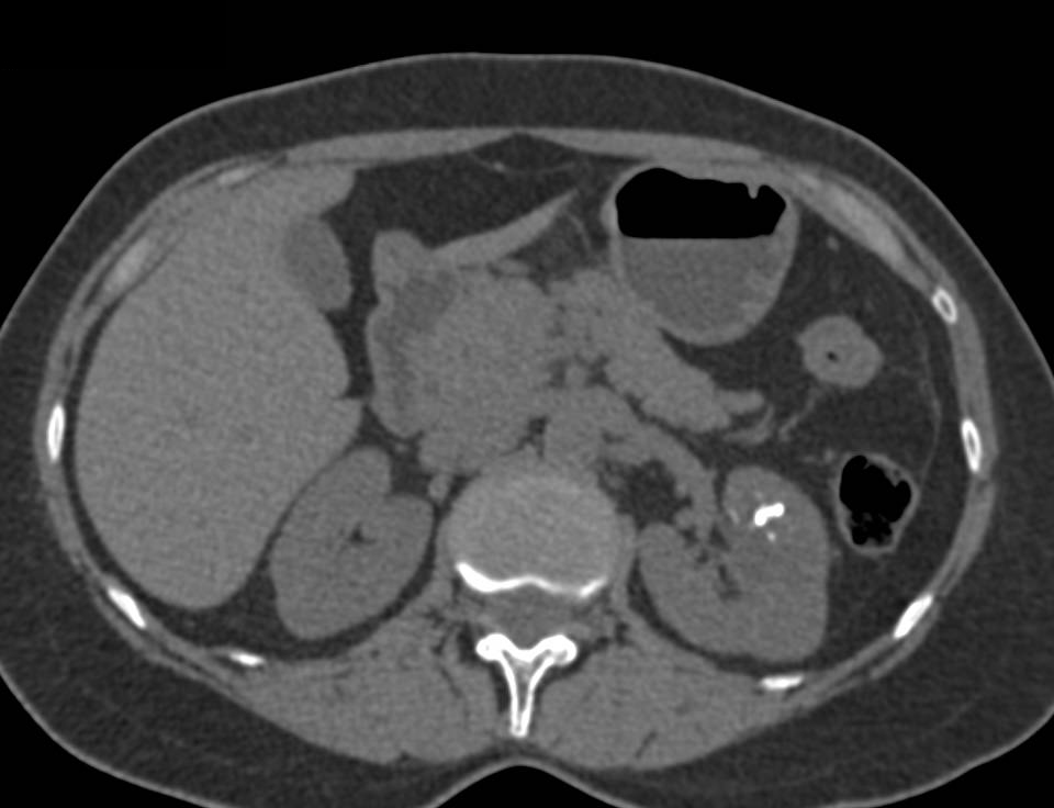 Renal Cyst with Calcification Without Enhancement - CTisus CT Scan