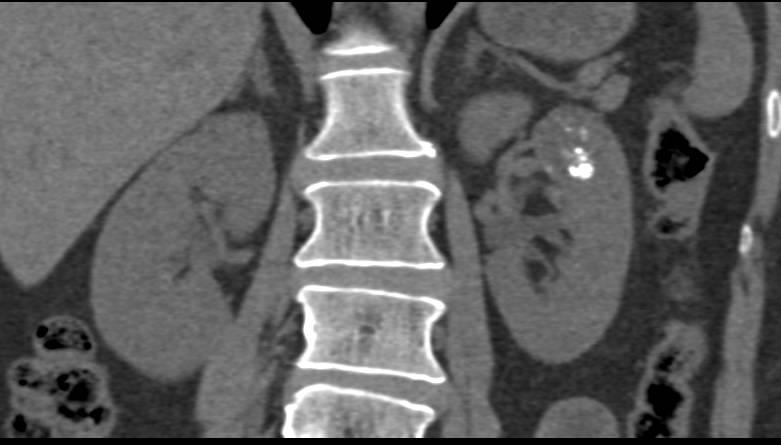 Bosniak 2F Cyst - CTisus CT Scan