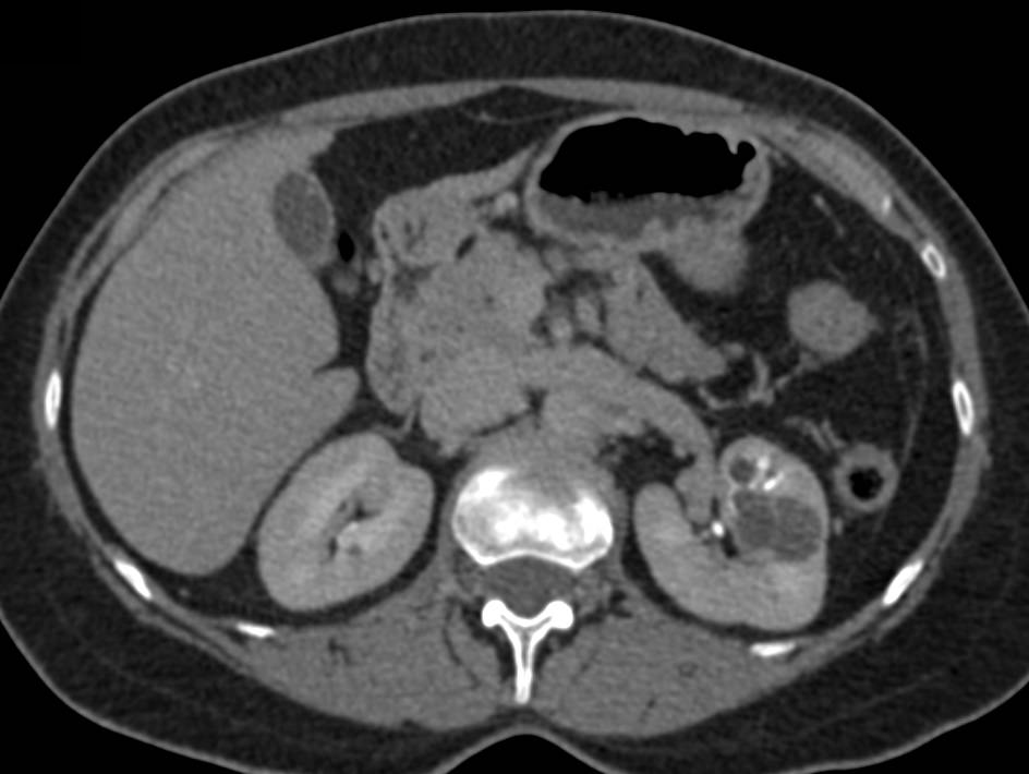 Bosniak 2F Cyst - CTisus CT Scan