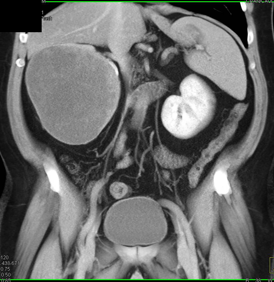 Cystic Renal Cell Carcinoma - CTisus CT Scan
