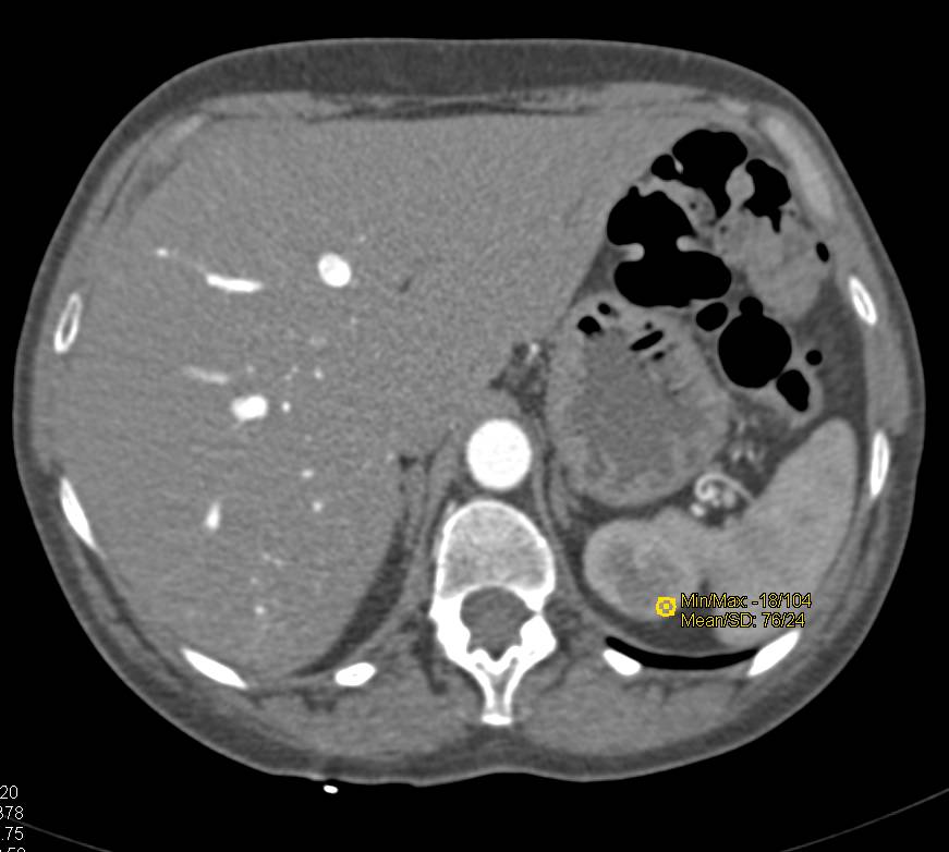 Renal Cyst - CTisus CT Scan