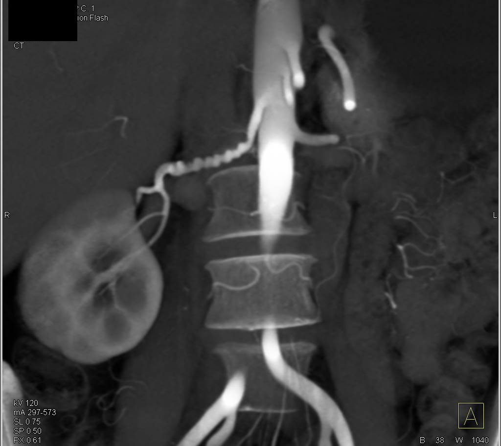 Fibromuscular Dysplasia Right Renal Artery (FMD) - CTisus CT Scan