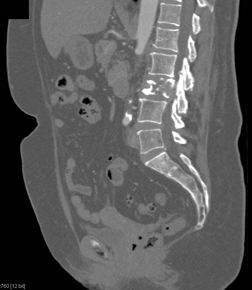 Recurrent Renal Cell Carcinoma Involves the Psoas Muscle and the L-Spine - CTisus CT Scan