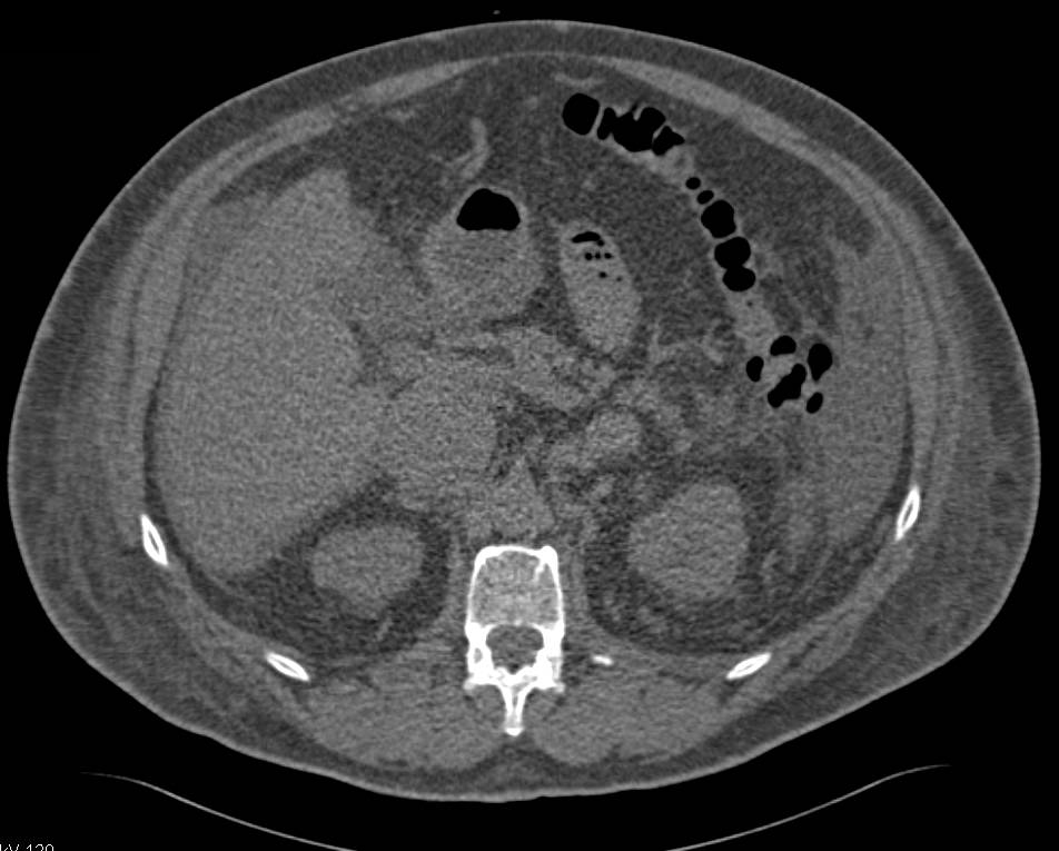 Renal Cell Carcinoma with Extension into Renal Vein, Inferior Vena Cava (IVC) and into the Right Atrium - CTisus CT Scan