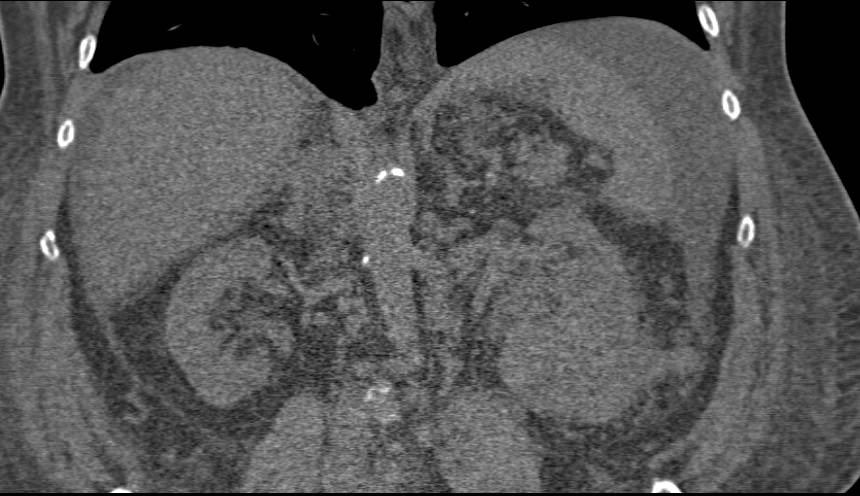 Renal Cell Carcinoma with Ascites - CTisus CT Scan