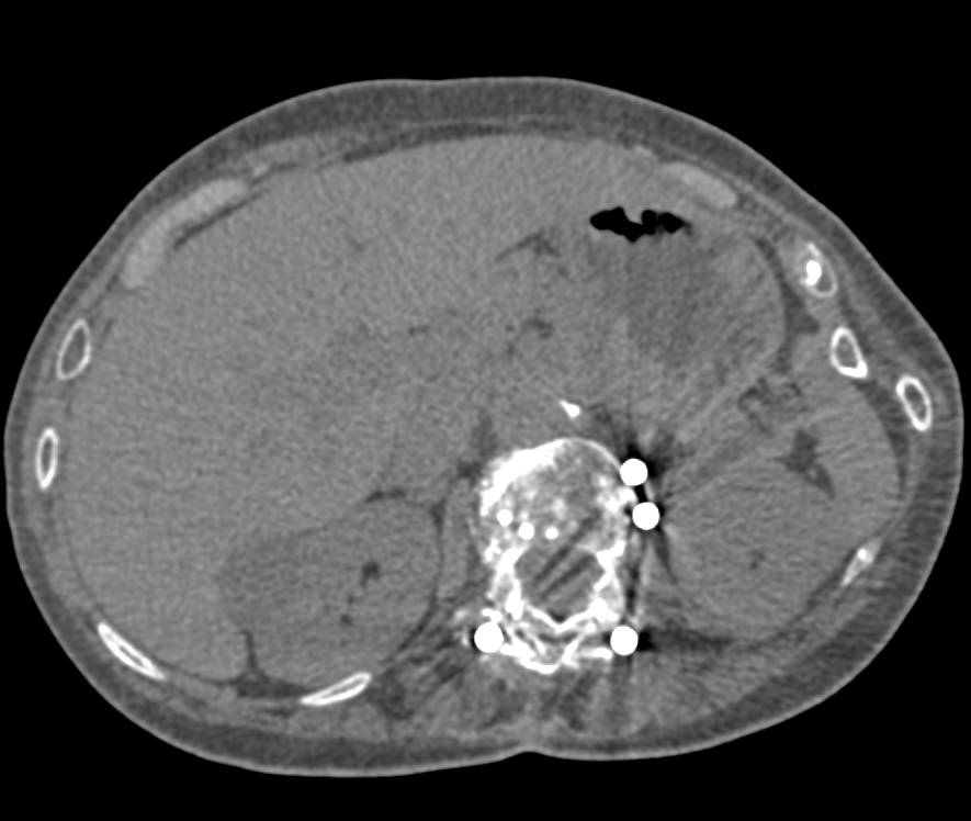 Cyst with Septation Right Kidney - CTisus CT Scan