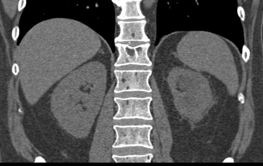 Bladder Cancer Invading and Obstructing the Left Ureter - CTisus CT Scan