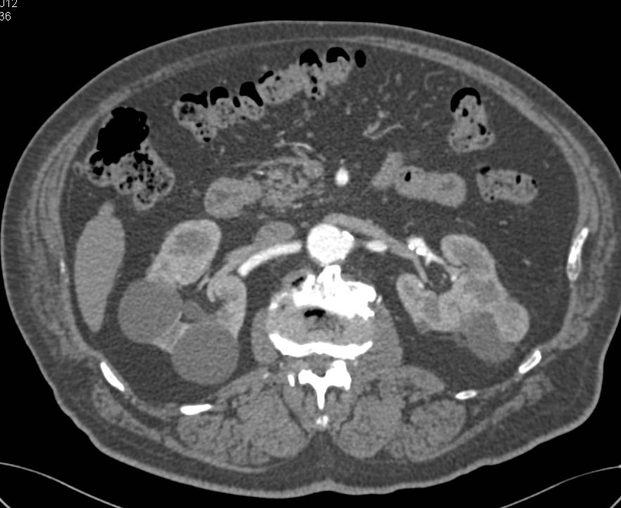 Multiple Renal Cysts Including A High Density Left Renal Cyst - CTisus CT Scan