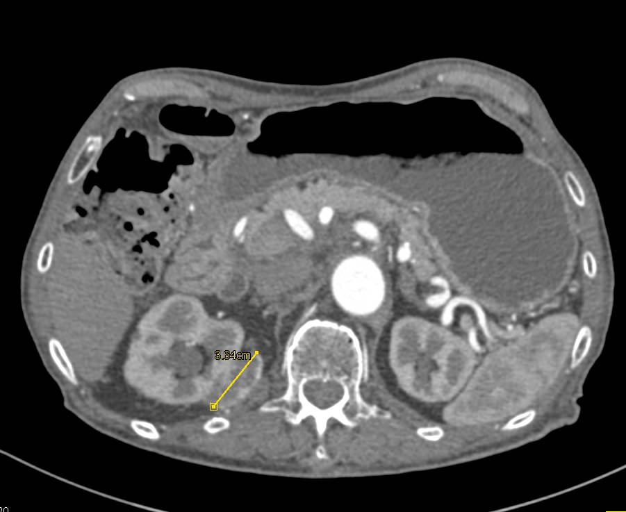 High Density Cyst Left Kidney and Renal Cell Carcinoma Right Kidney - CTisus CT Scan