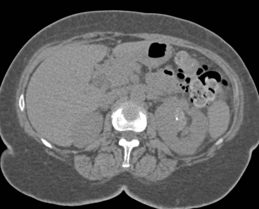 Papillary Left Renal Cell Carcinoma - CTisus CT Scan
