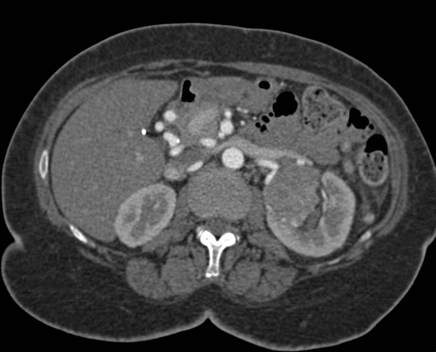 Papillary Renal Cell Carcinoma Left Kidney - CTisus CT Scan