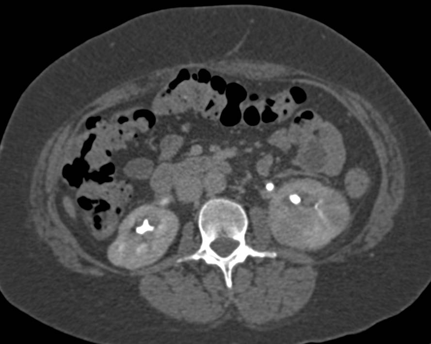 Acute Pyelonephritis Left Kidney - CTisus CT Scan