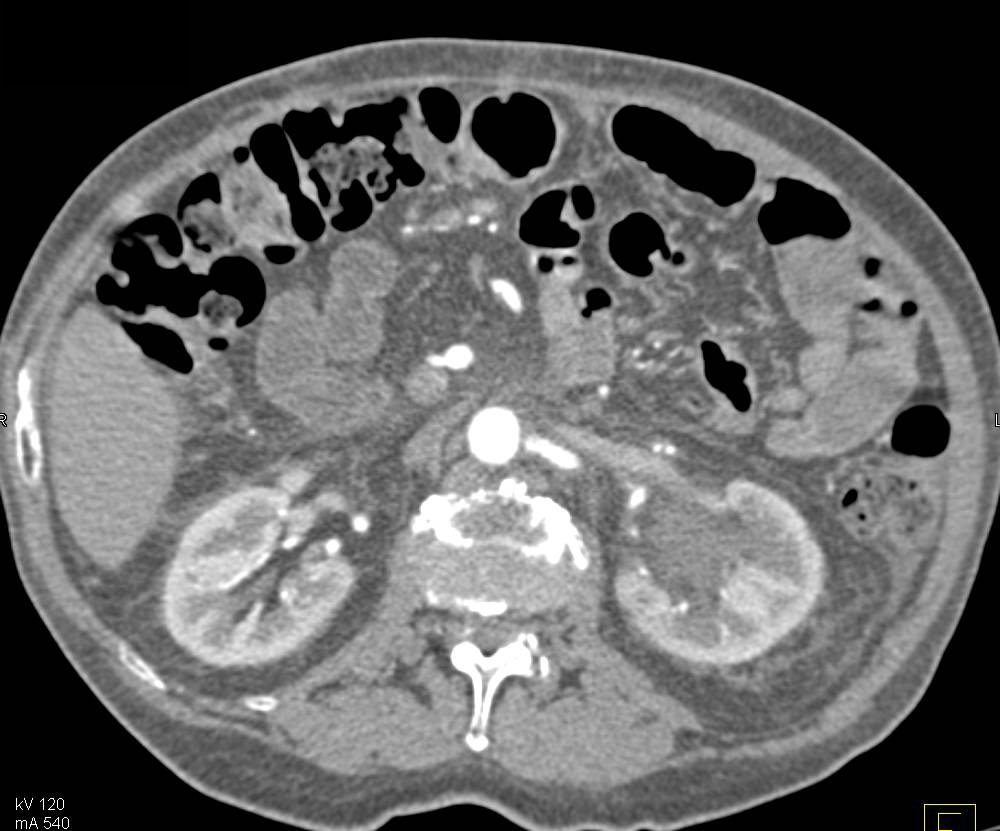 Obstruction of Left Kidney by Central Stone in Renal Pelvis - CTisus CT Scan