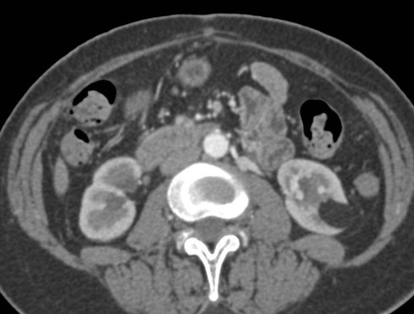 Left Renal Angiomyolipoma - CTisus CT Scan
