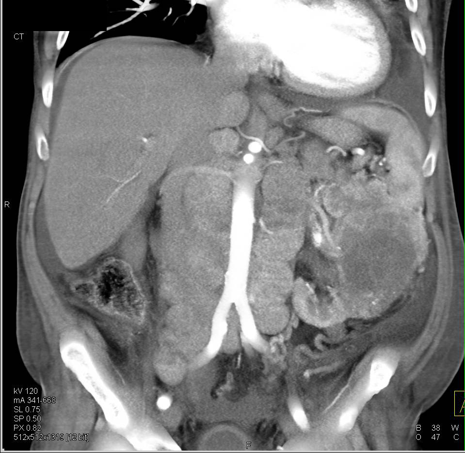Renal Cell Carcinoma with Bulky Adenopathy - CTisus CT Scan