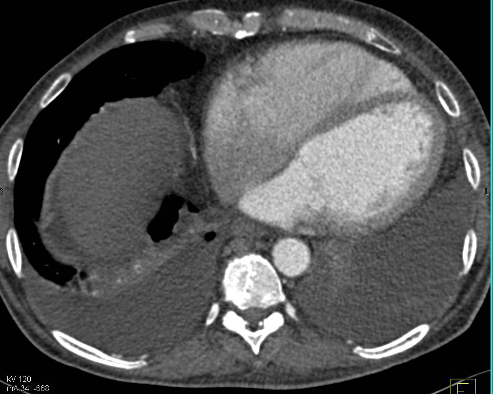 Renal Cell Carcinoma with Bulky Para-aortic Adenopathy - CTisus CT Scan