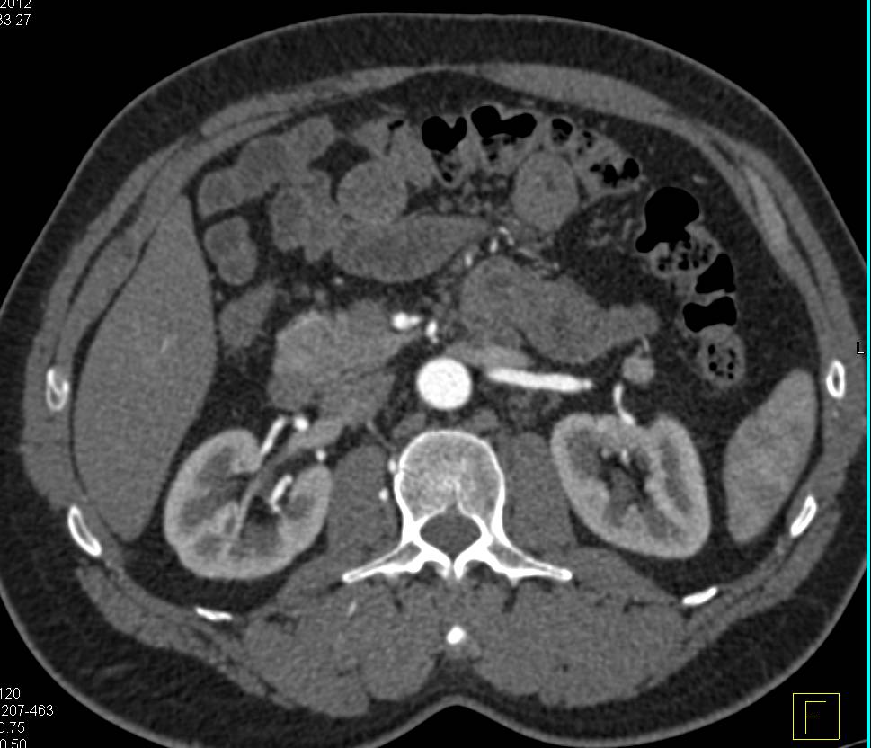 Unusual Lateral Tracking of the Ureters on CT Urography - CTisus CT Scan