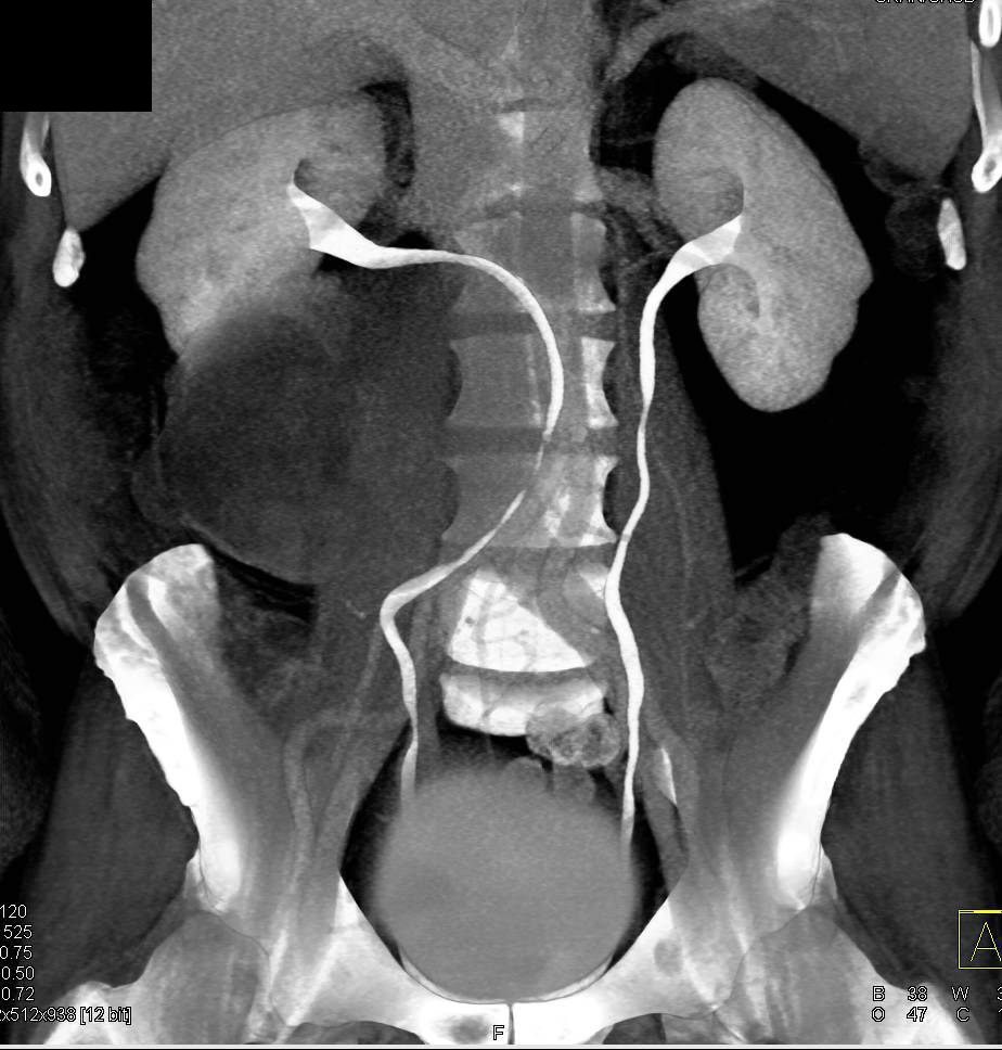 Cystic Renal Cell Carcinoma Displaces the Ureter - CTisus CT Scan