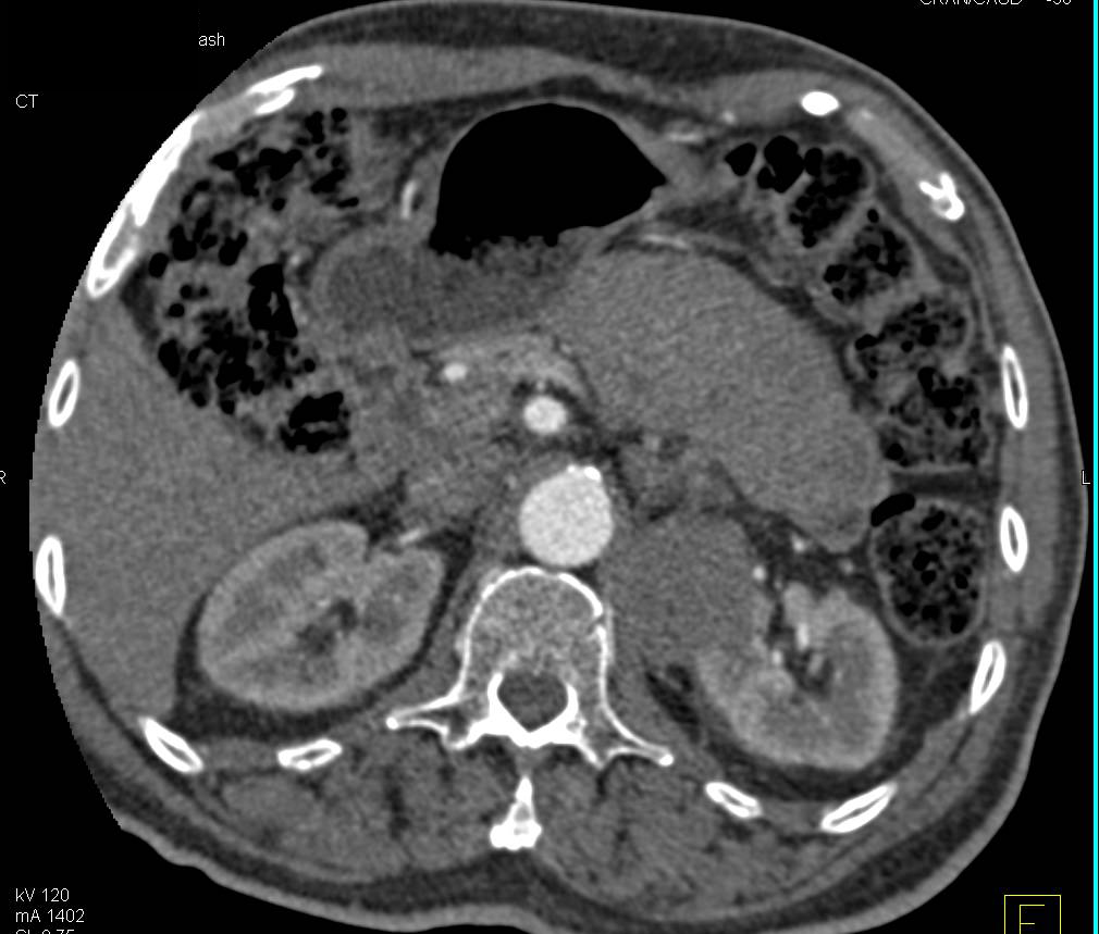 Renal Cell Carcinoma - CTisus CT Scan