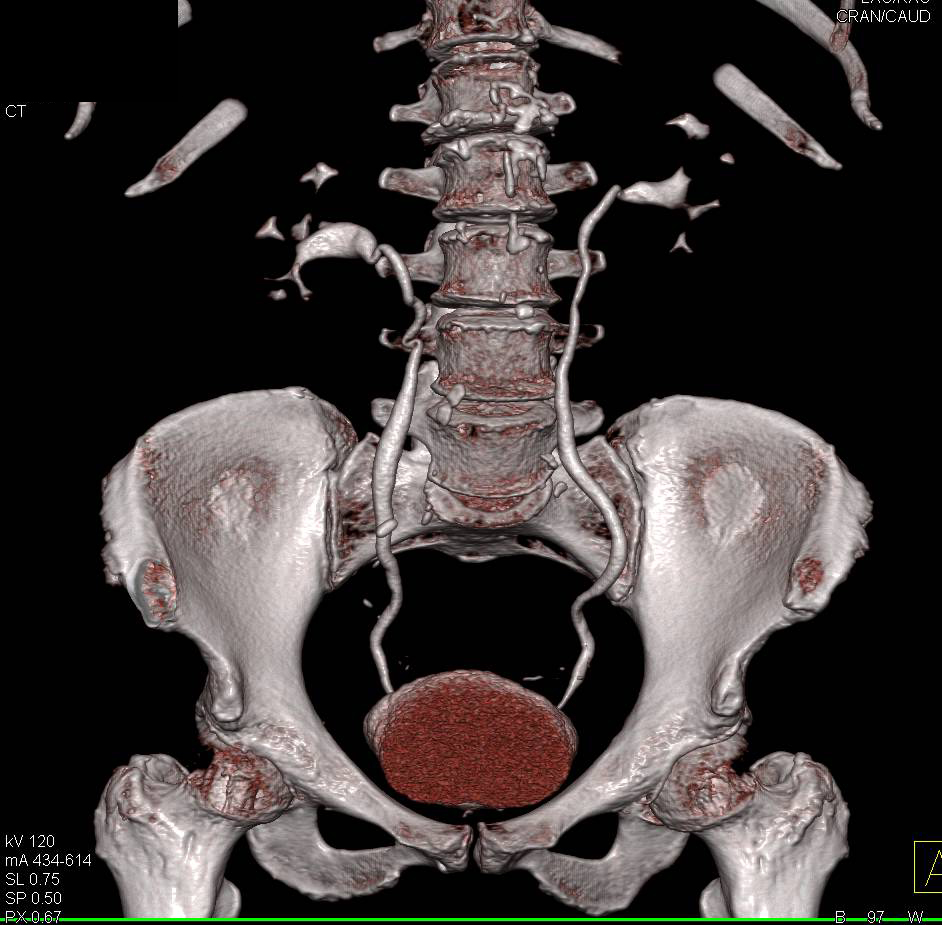 Normal CT Urogram - CTisus CT Scan
