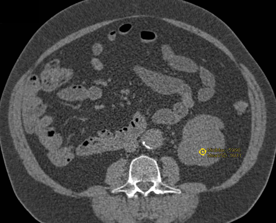 High Density Renal Cyst - CTisus CT Scan
