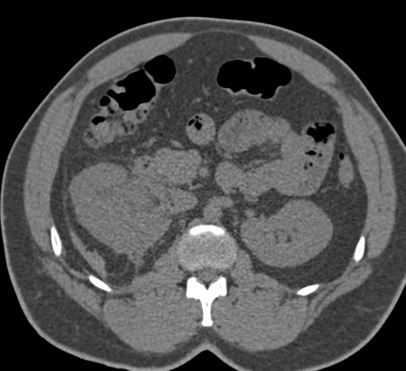 Filling Defects Right Collecting System due to Blood Clots - CTisus CT Scan