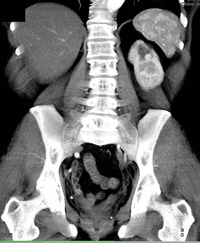 Renal Artery Aneurysm s/p Radiofrequency Ablation (RFA) - CTisus CT Scan