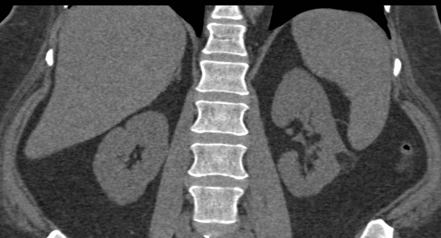 Renal Angiomyolipoma - CTisus CT Scan