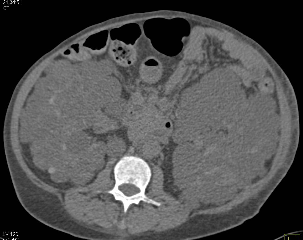 Polycystic Kidney Disease - CTisus CT Scan