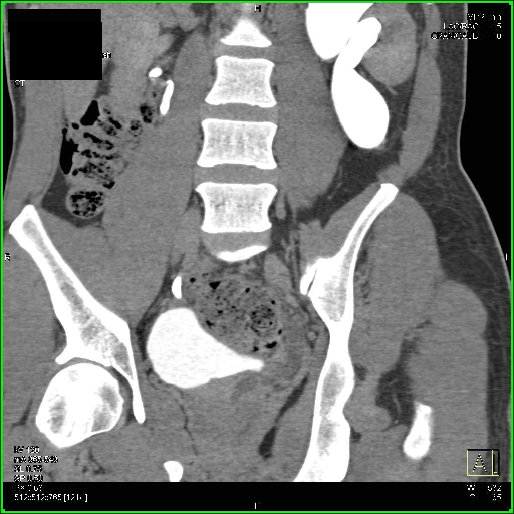 Left Ureter has Aberrant Distal Course into the Prostate Gland - CTisus CT Scan