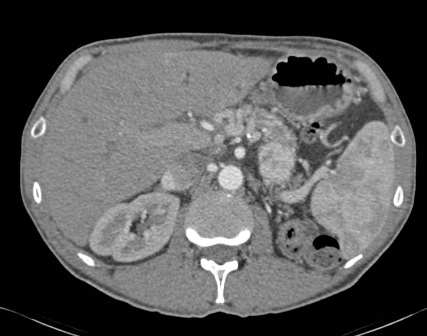 Recurrent Renal Cell Carcinoma Metastatic to the Pancreas - CTisus CT Scan