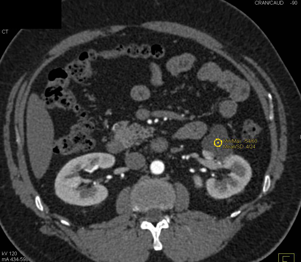 Simple Left Renal Cyst - CTisus CT Scan