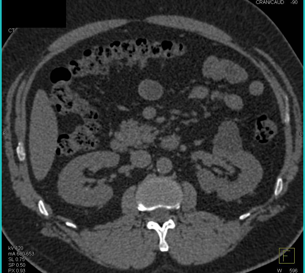 Bosniak 1 Cyst Left Kidney - CTisus CT Scan
