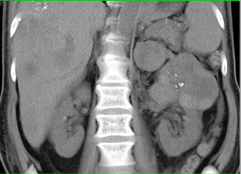 Clear Cell Renal Cell Carcinoma With Adrenal and Liver Metastases - CTisus CT Scan